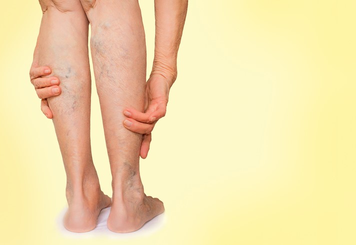 Quais os sintomas da má circulação nas pernas e como tratar?