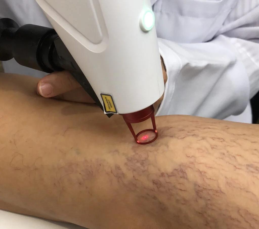 Tratamento a laser para curar vasinhos está em alta entre os famosos